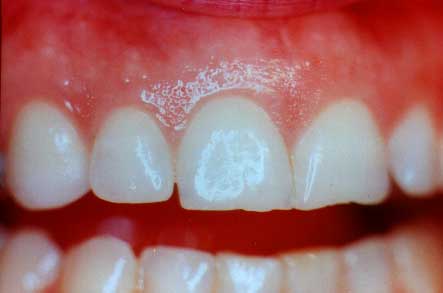 What+color+are+healthy+gums