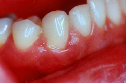 gum disease